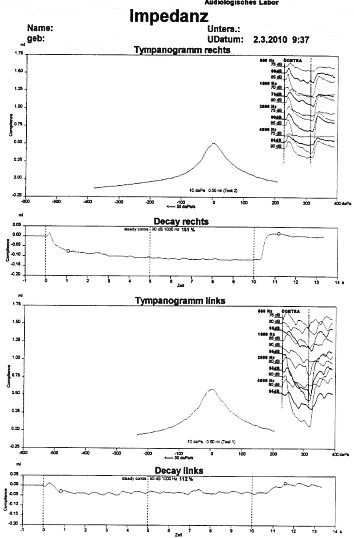 Tympanogramm.JPG