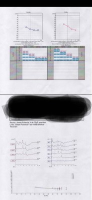 Audiogram